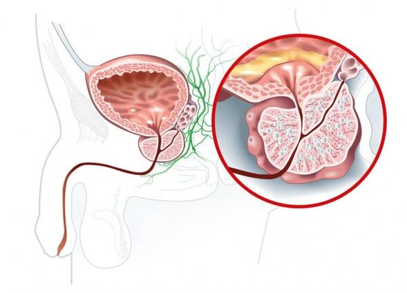 Sintomas de prostatite