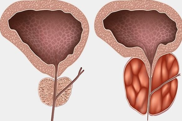 Inflamação da próstata