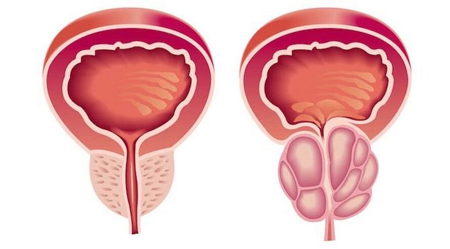 Próstata saudável e inflamada com prostatite