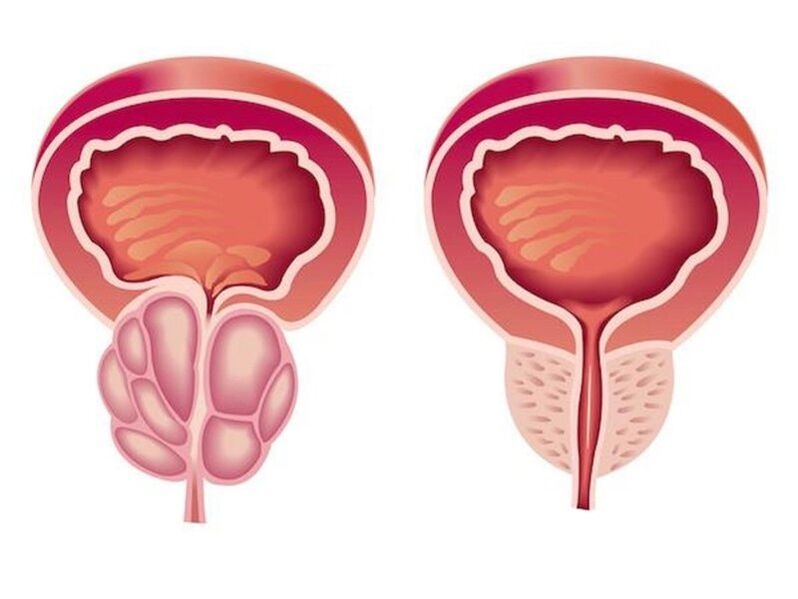 Como é a prostatite
